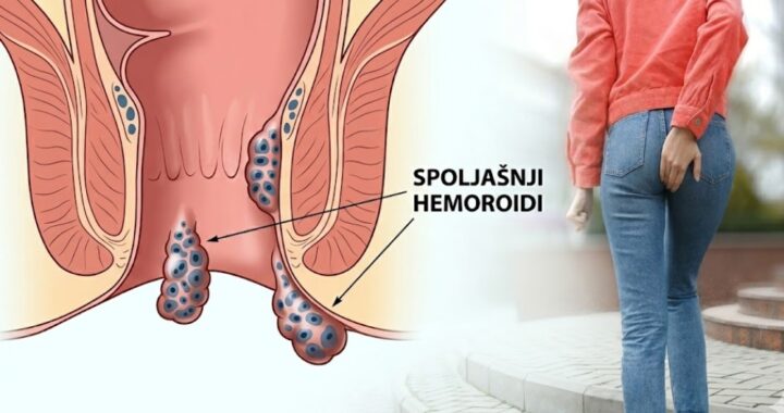 Spoljašnji hemoroidi – Šta pomaže brzo i efikasno