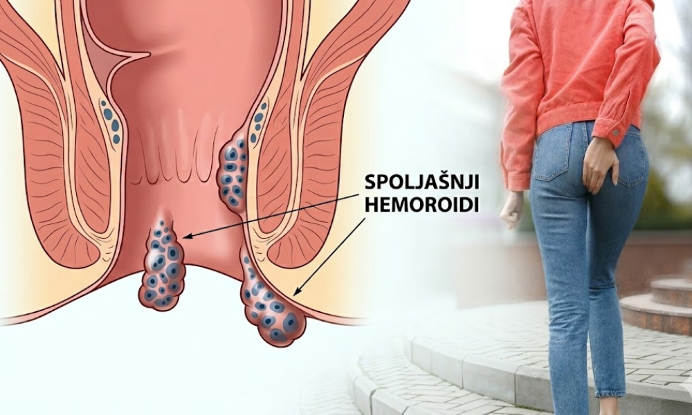 Spoljašnji hemoroidi - Šta pomaže brzo i efikasno